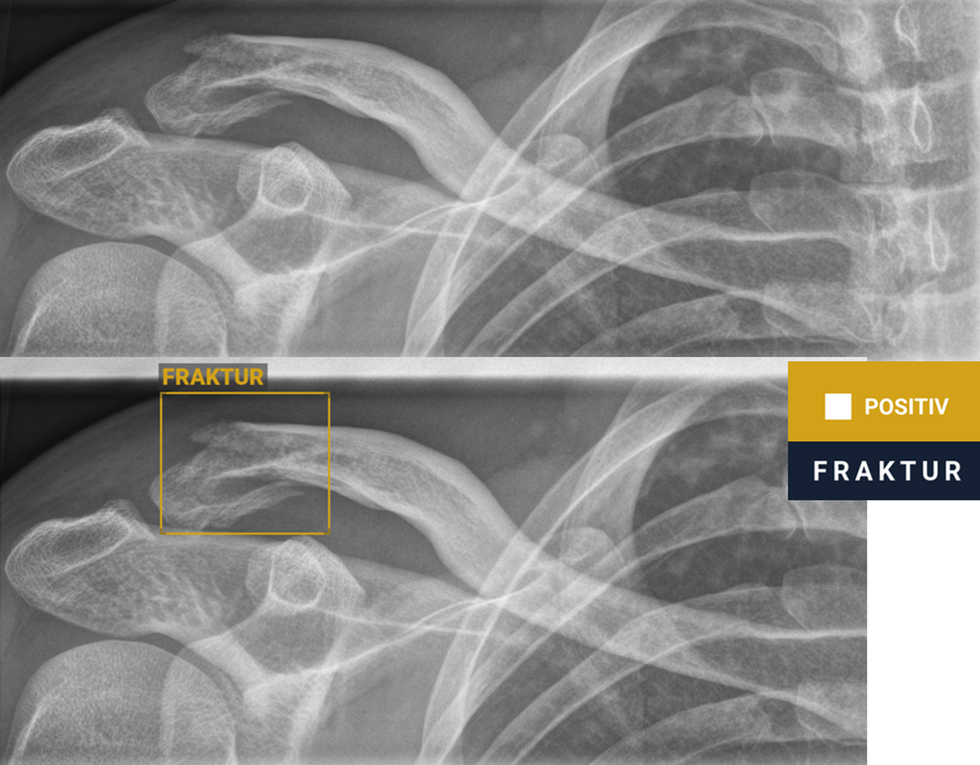 <p>KI sorgt für „intelligentes“ Röntgenbild mit Frakturnachweis (Bruch des rechten Schlüsselbeins). (Bild: BG Klinikum Duisburg)</p>