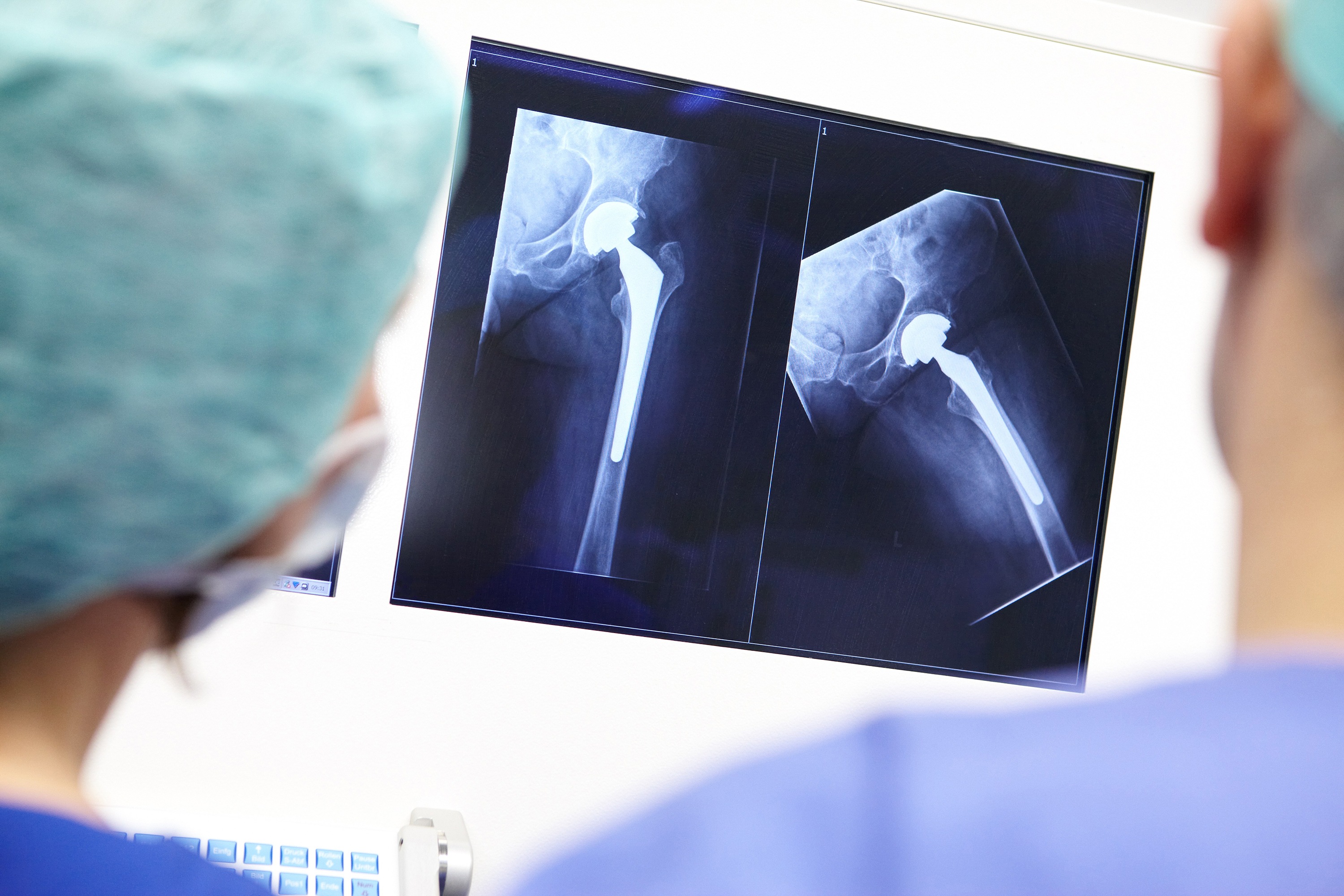 <p>Röntgenbild einer Hüfte nach Einbau eines Implantats. (Bild: BG Klinikum Duisburg / Marcus Gloger / cap communications)&nbsp;</p>