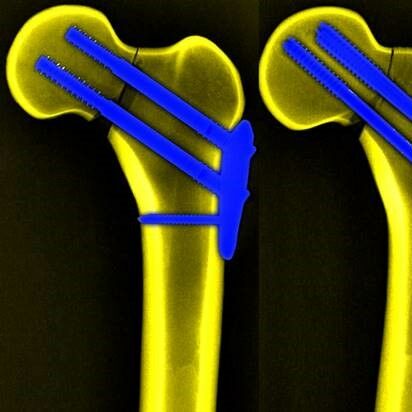 Röntgenaufnahme zweier geschraubter Knochen
