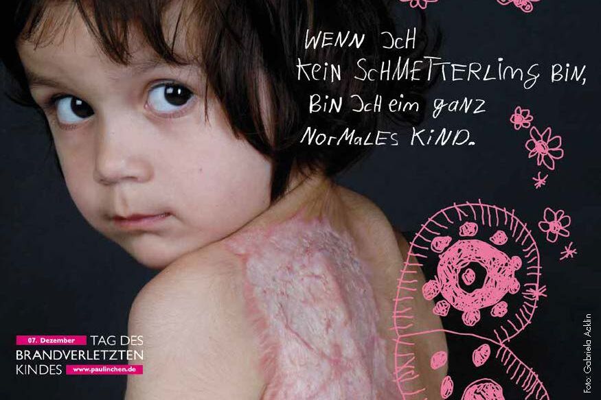 Tag des brandverletzten Kindes Tag des brandverletzten Kindes