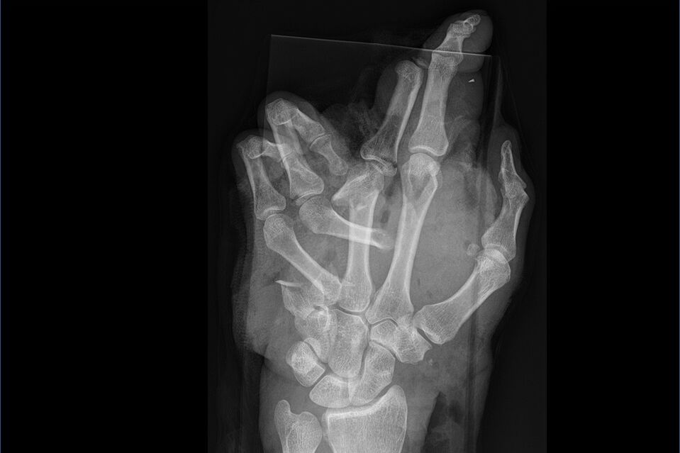 Röntgenaufnahme Handverletzung