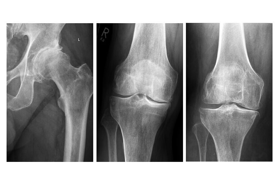 Röntgenbilder einer Arthrose des Hüftgelenkes und des Kniegelenkes